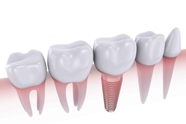 dental implant restoration